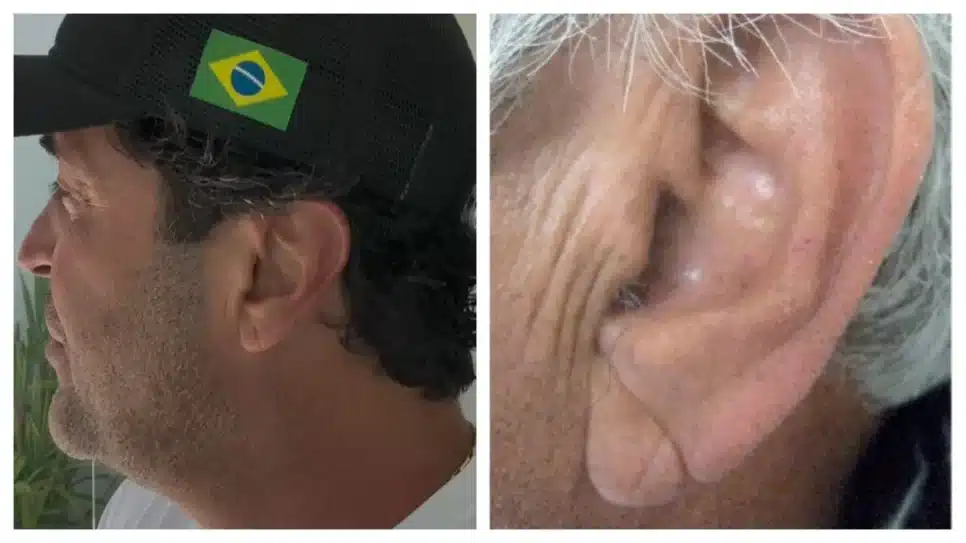 Montagem mostra o sinal de Frank no lóbulo da orelha do influenciador Henrique Maderite (à esq.) e de um participante de estudo da Standord, nos EUA