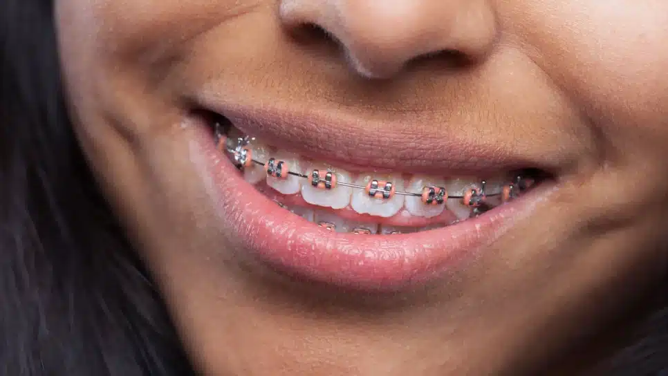 Dentes podem entortar mesmo após o uso de aparelho ortodôntico